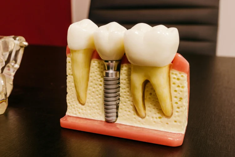 Dental implants and screw on table illustrating single tooth implant cost