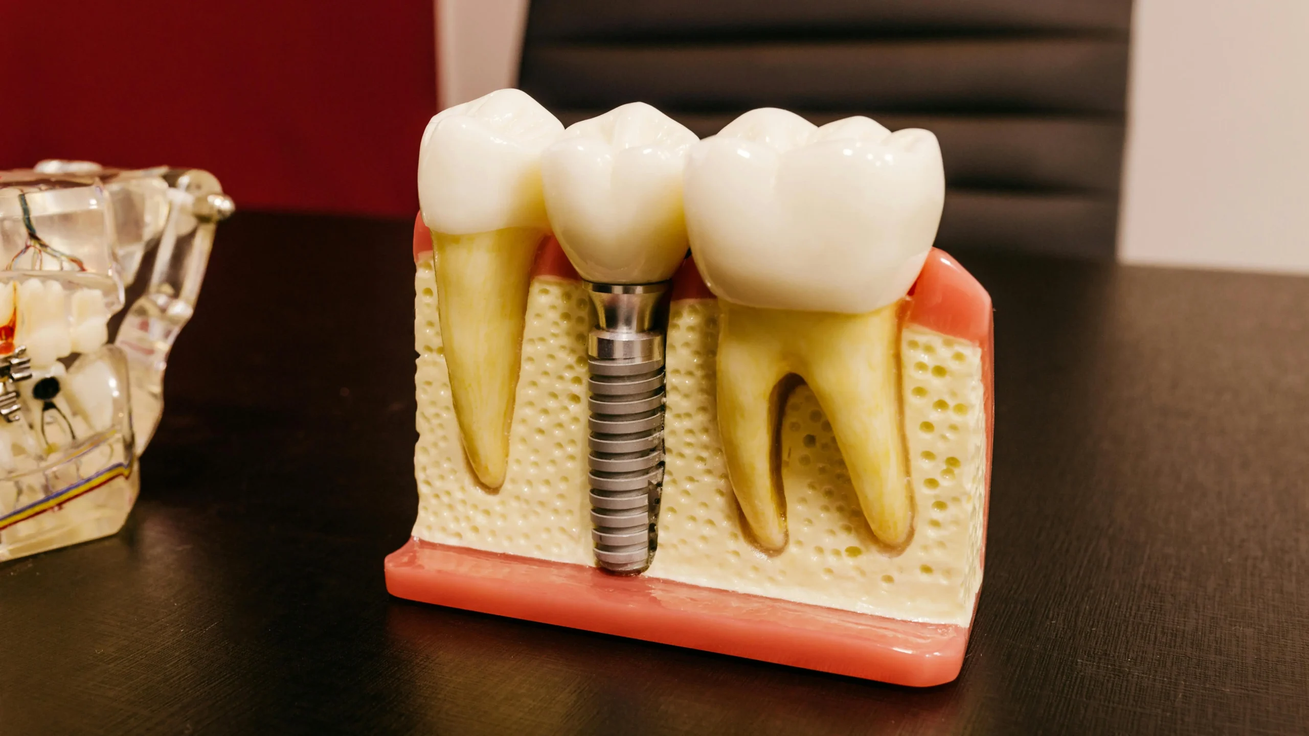 Dental implants and screw on table illustrating single tooth implant cost