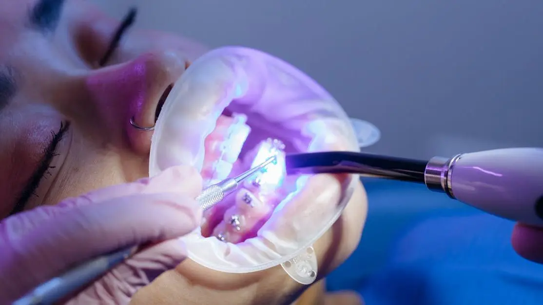 Close-up of dental brackets being maintained during braces maintenance.