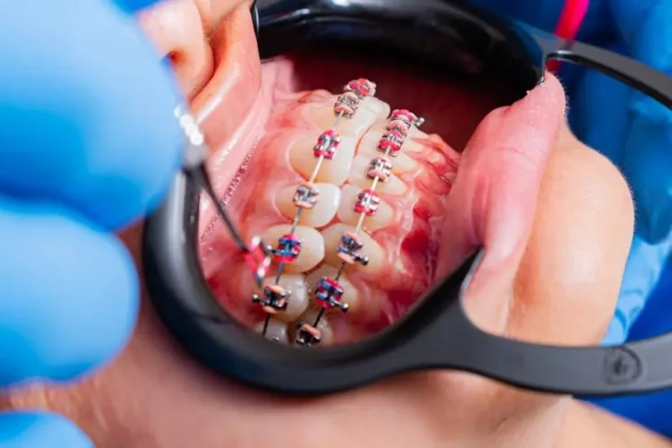 Dentist adjusting brackets on a patient's teeth for clear aligners vs brackets comparison.