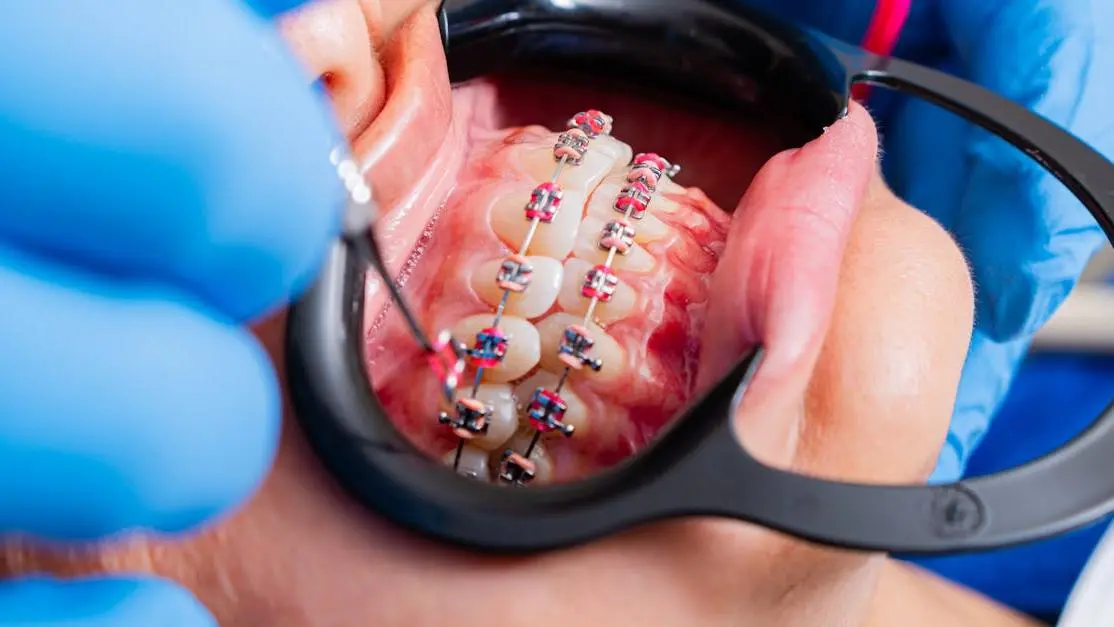 Dentist adjusting brackets on a patient's teeth for clear aligners vs brackets comparison.