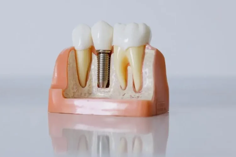 Dental implant model close-up: Dentures vs. dental implants comparison