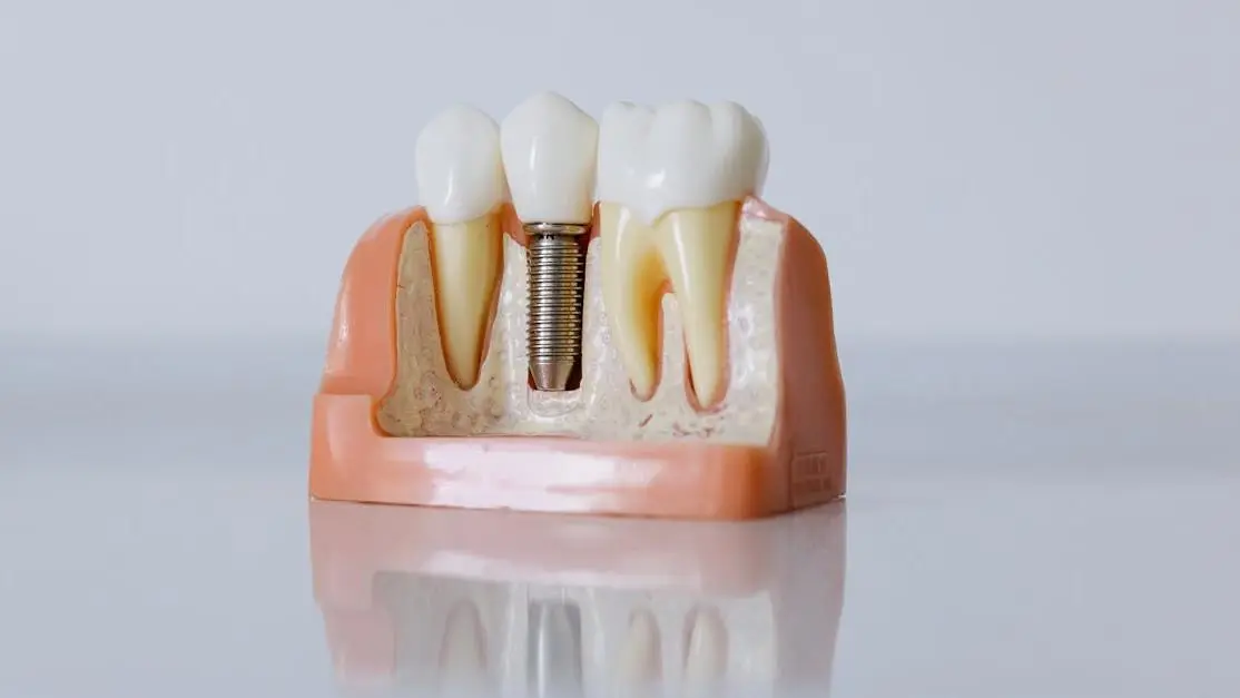 Dental implant model close-up: Dentures vs. dental implants comparison