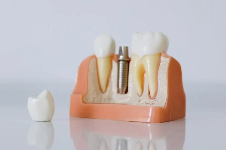 Dental implant model illustrating the difference between dental implants and dentures