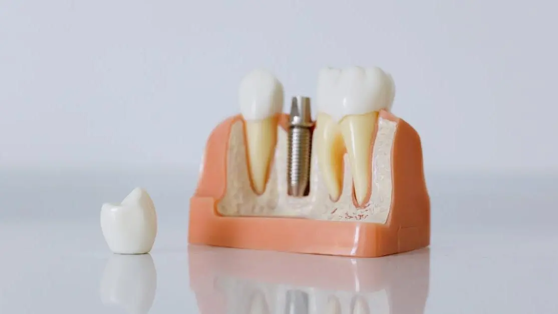 Dental implant model illustrating the difference between dental implants and dentures