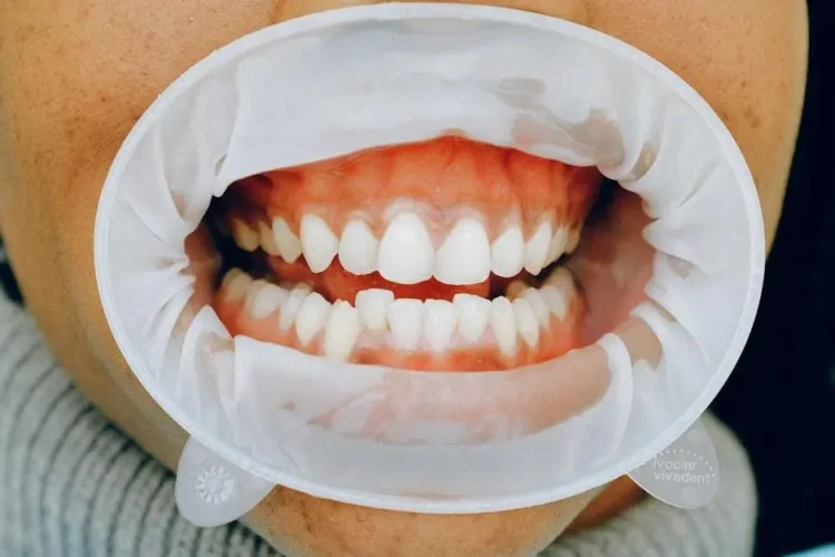 Dental examination showing effects of smoking on oral health.