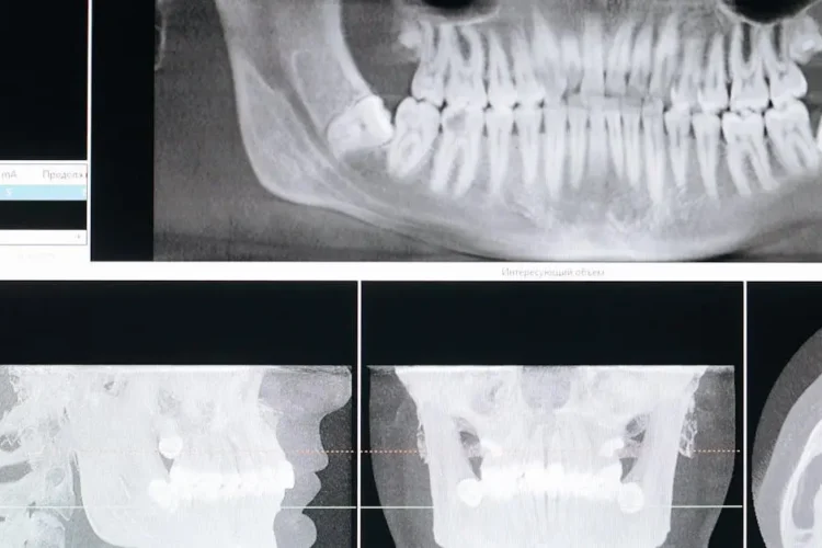 X-ray showing potential hard seltzers dental impact