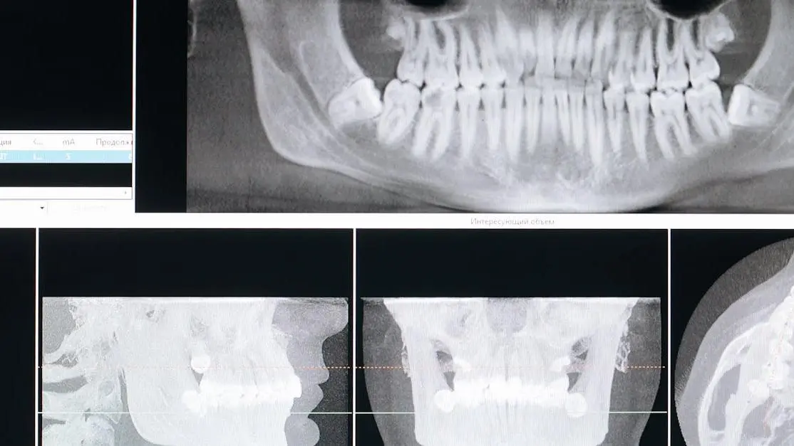 X-ray showing potential hard seltzers dental impact