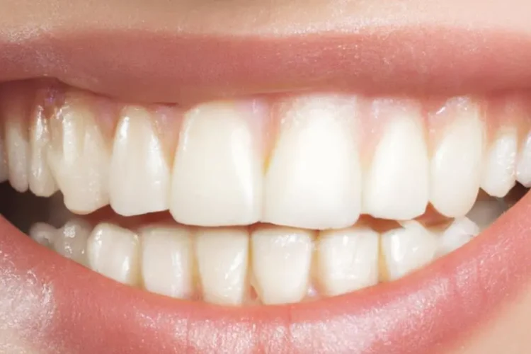 Gummy smile with white teeth, associated with periodontal disease.