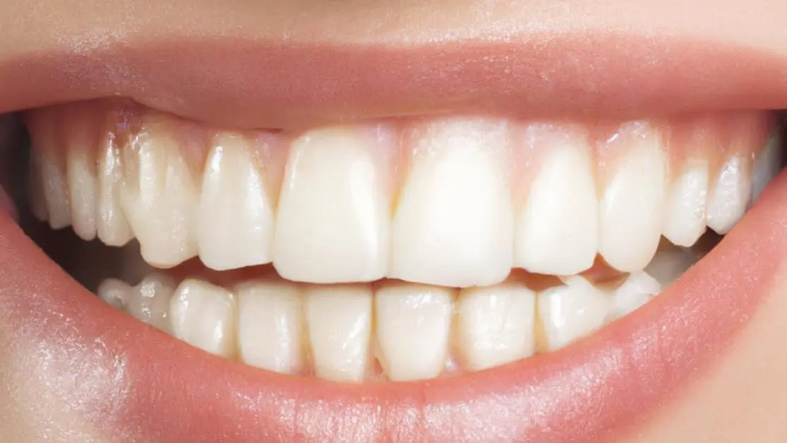 Gummy smile with white teeth, associated with periodontal disease.