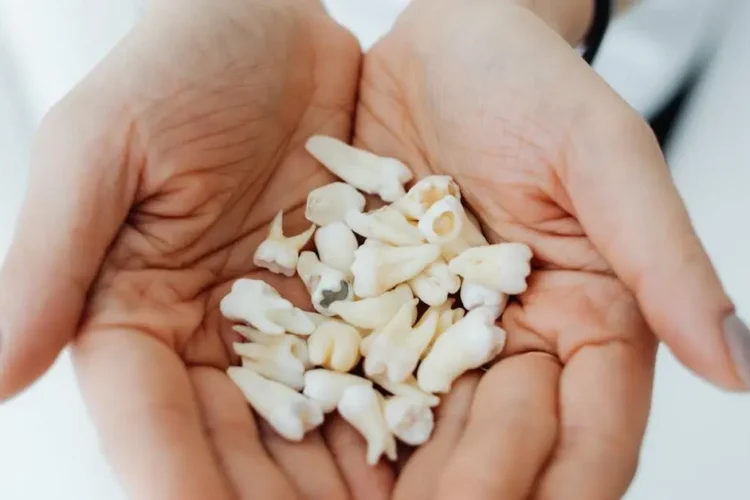 Person Holding Teeth, Highlighting Tooth Decay