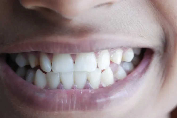 Close-up of teeth showing gum lifts