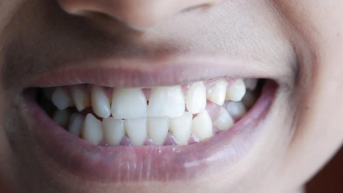 Close-up of teeth showing gum lifts