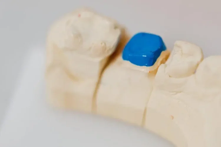 Dental jaw model with blue filling indicating signs you need a root canal.