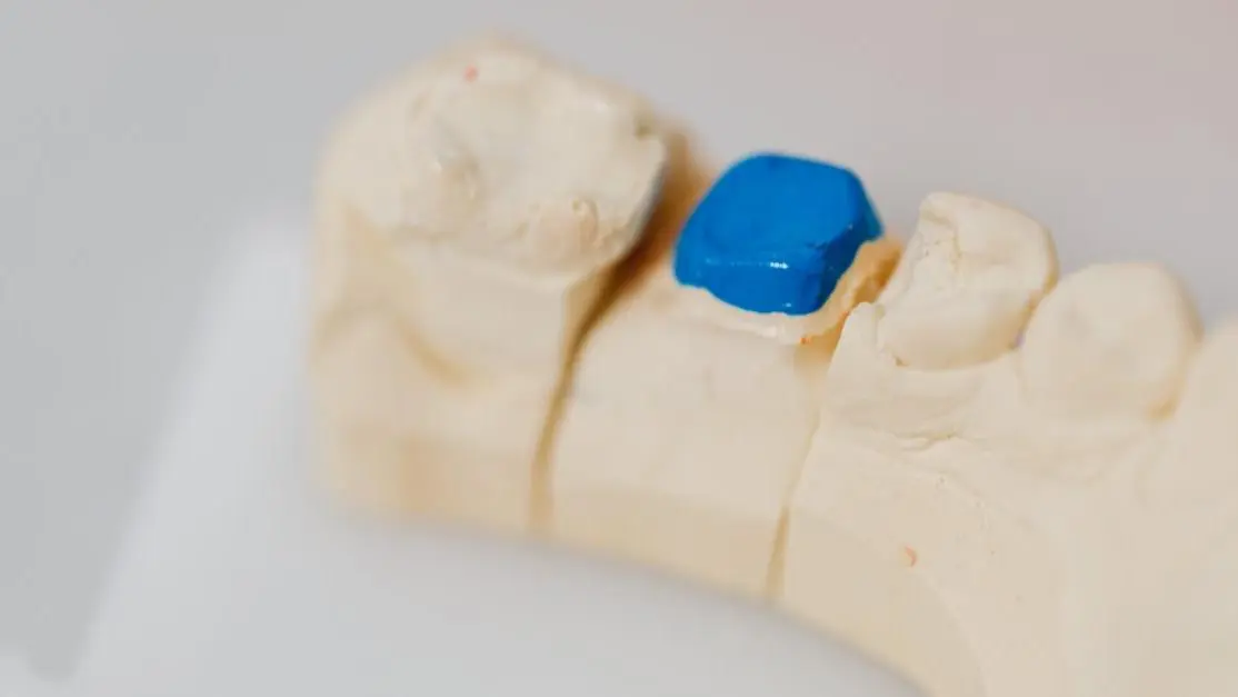 Dental jaw model with blue filling indicating signs you need a root canal.